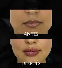 Fillers resultado